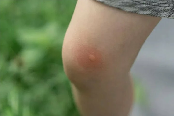 Flaster kundër pickimeve Chicco Bite Plasters 30 copë, transparent